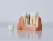 perte de poids après retrait implant
