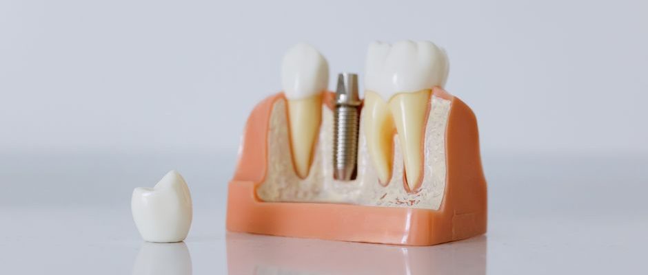 perte de poids après retrait implant