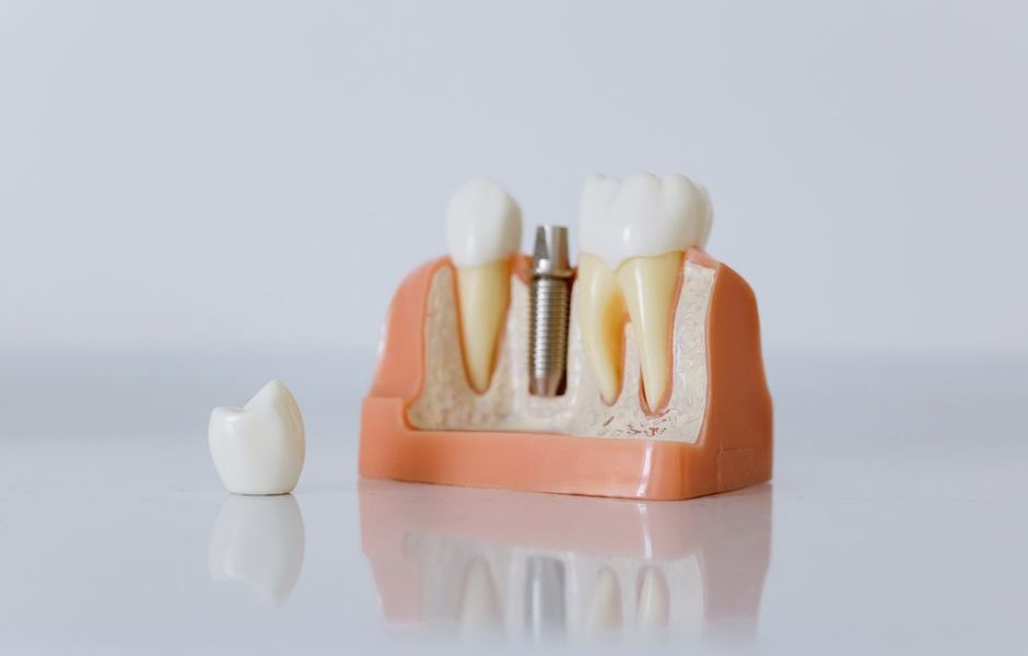 perte de poids après retrait implant